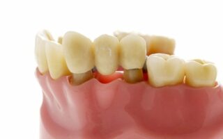 تركيب الأسنان المتحركة