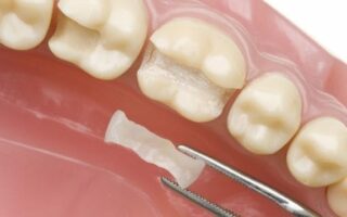 ترميم الأسنان طبيعياً