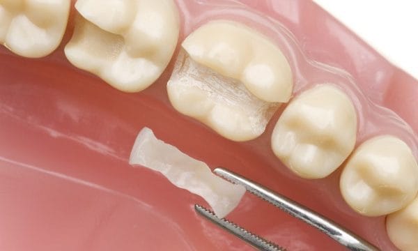 ترميم الأسنان طبيعياً