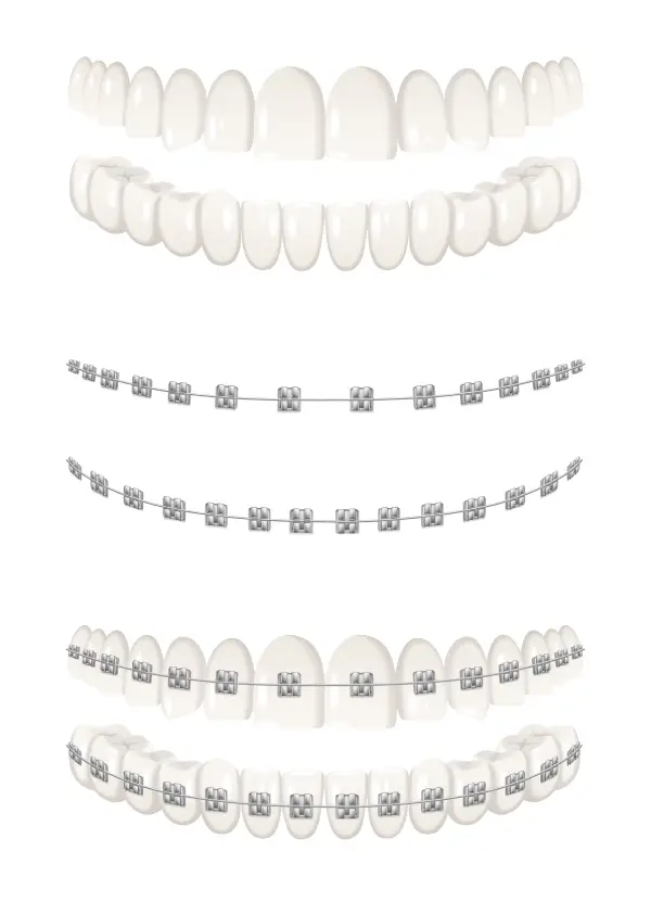 مميزات و انواع اسعار تقويم الاسنان في جدة