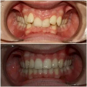 تقويم الاسنان المعدني مكوناتها واسبابها