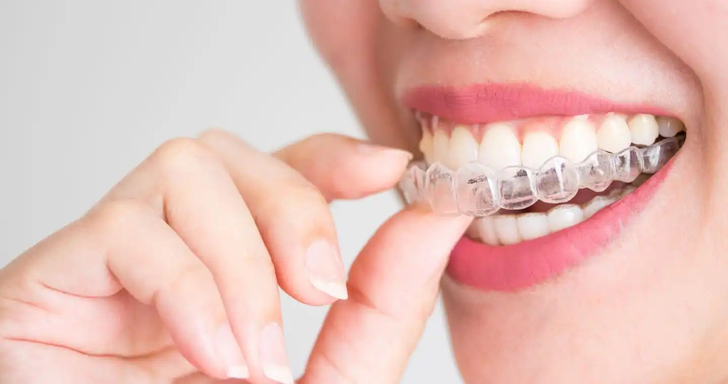 صورة توضح تقويم الاسنان الشفاف Invisalign
