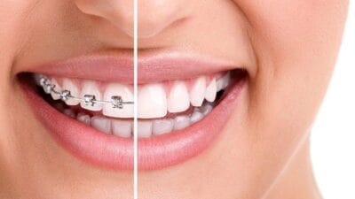 تقويم الاسنان المعدني مكوناتها واسبابها