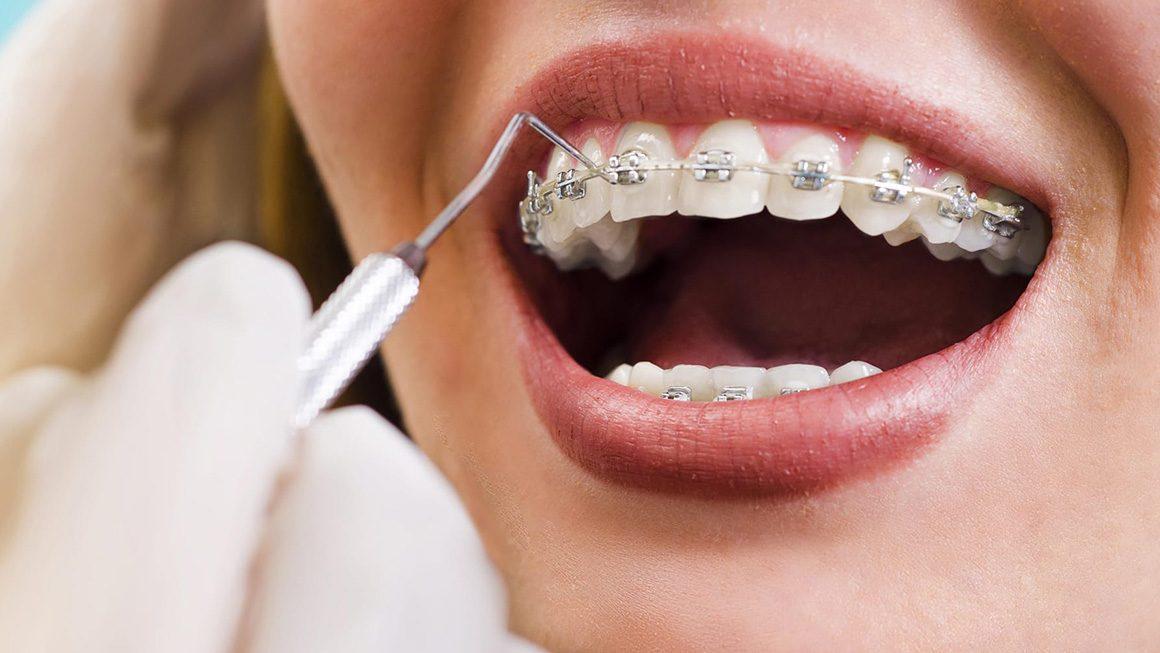 ما هي المدة الزمنية التى تبدأ الأسنان تتحرك بعد التقويم ؟