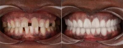 تقويم الاسنان المعدني مكوناتها واسبابها