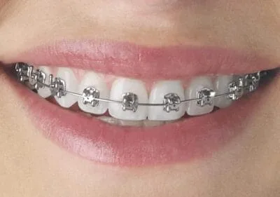 تقويم الاسنان المعدني بالصور من مجمع البطل التخصصي