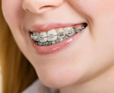 تقويم الاسنان المعدني بالصور من مجمع البطل التخصصي