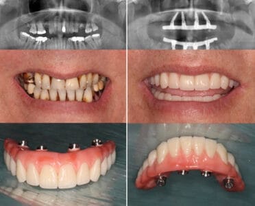 صورة تعبر عن زراعة الاسنان الرقمية قبل وبعد العملية