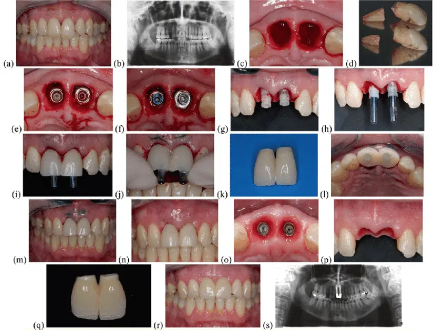 صور متنوعة لزراعة الأسنان الفورية قبل وبعد بالصور