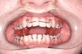 تقويم الأسنان المتحرك بالصور