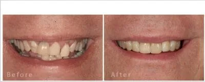 صورة تعبر عن زراعة الاسنان الرقمية قبل وبعد العملية