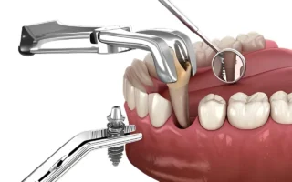 صورة تعبر عن عملية زراعة الاسنان الفورية وفيها اسنان تزرع بواسطة طبيب