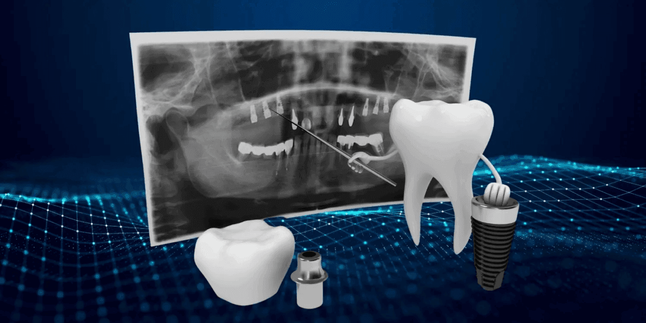 صورة اسنان رقمية اثناء عملية زراعة الاسنان الرقمية وبها صورة اشعه