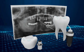 صورة اسنان رقمية اثناء عملية زراعة الاسنان الرقمية وبها صورة اشعه