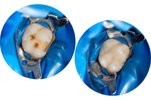 2. حشو الحشوات المركبة (الراتنجية)