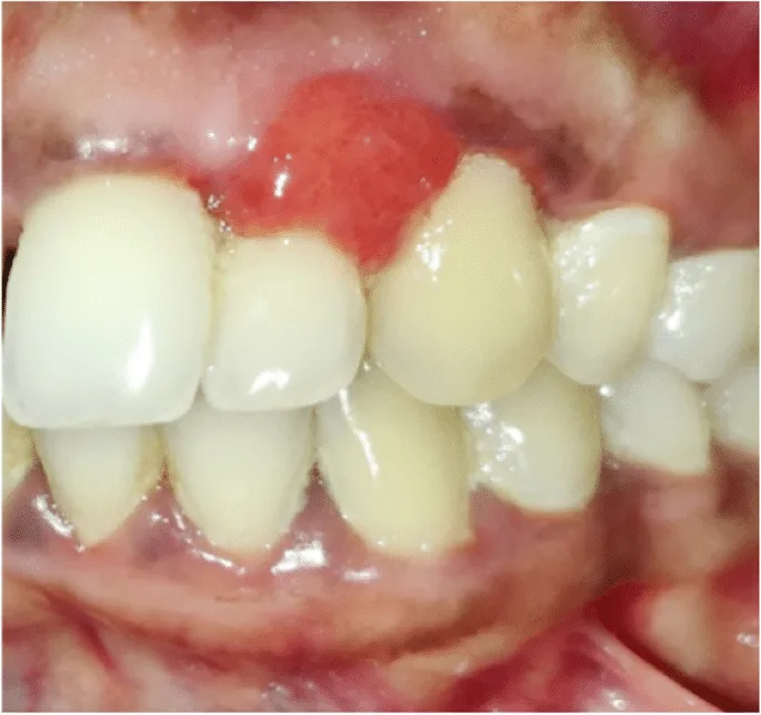 التهاب اللثة الحاد الدوائي