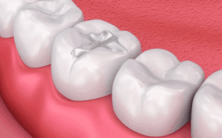 حشو الأسنان: أنواع، أسعار، خطوات، نصائح