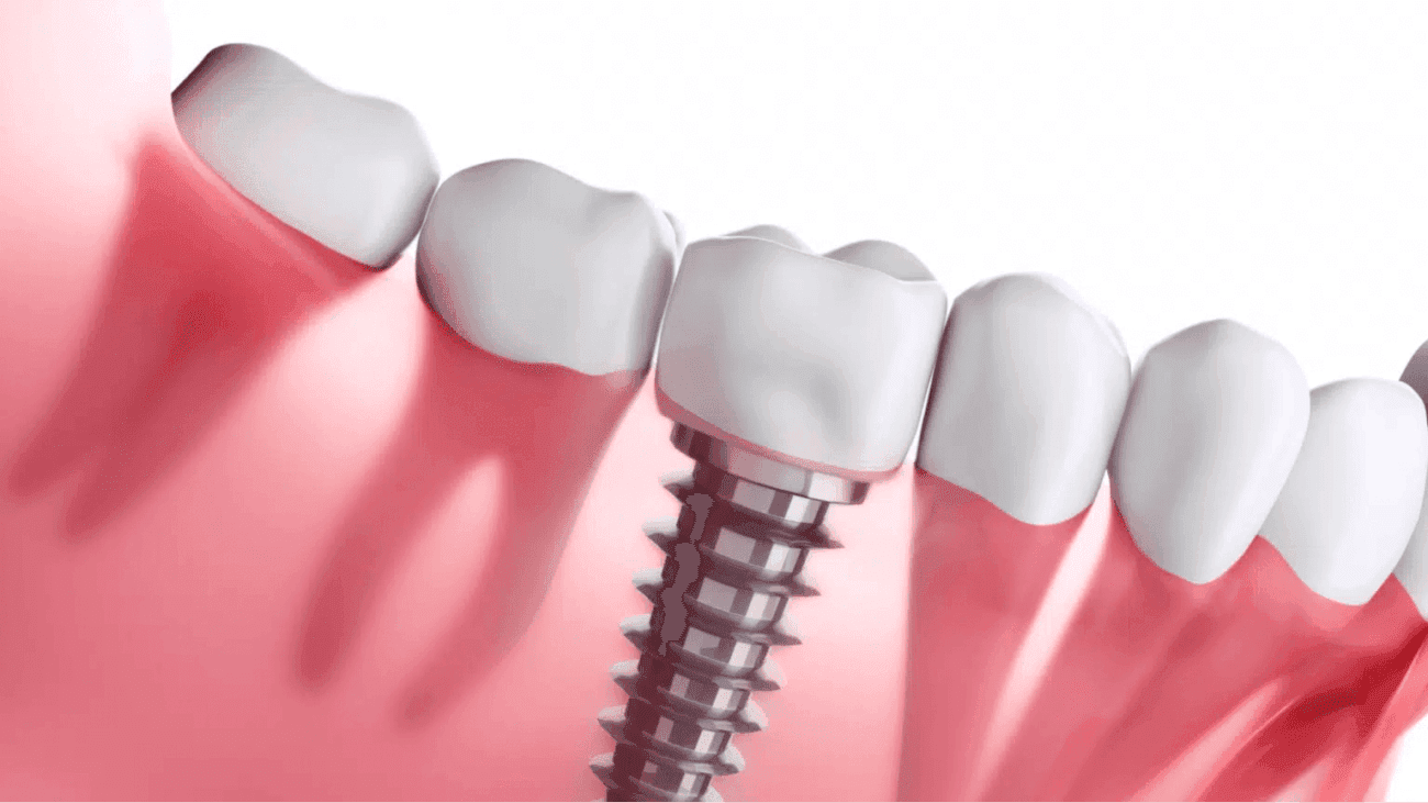 أسعار زراعة الأسنان