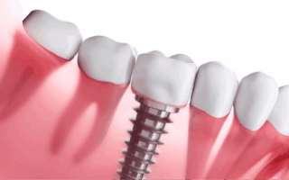 أسعار زراعة الأسنان