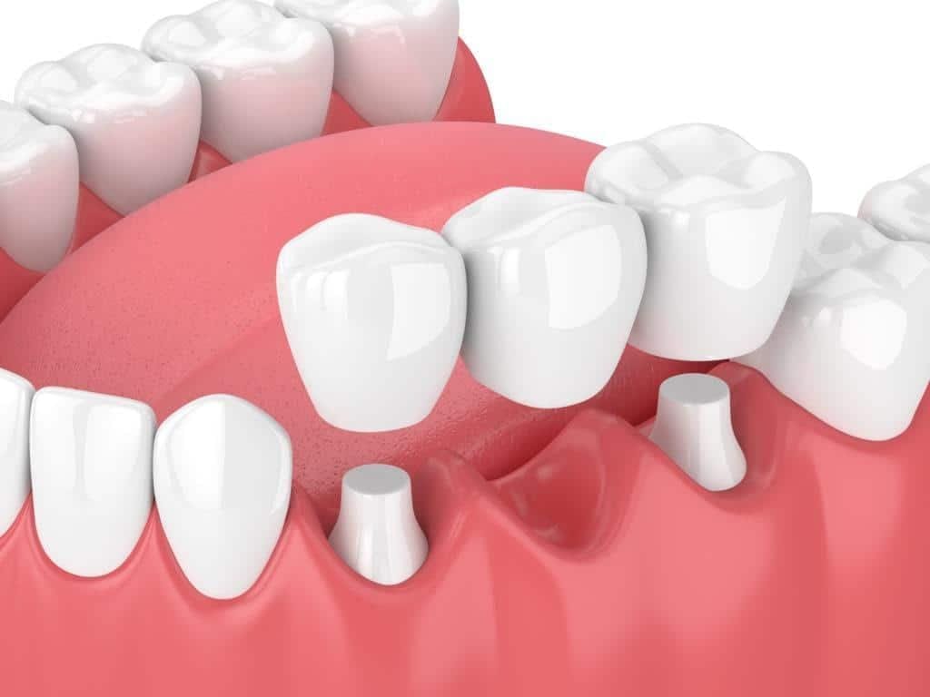 بدائل زراعة الأسنان في مركز الأسنان بمجمع بطل 