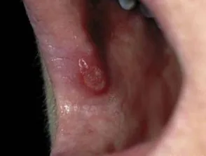 شكل  وصور تقرحات الفم 