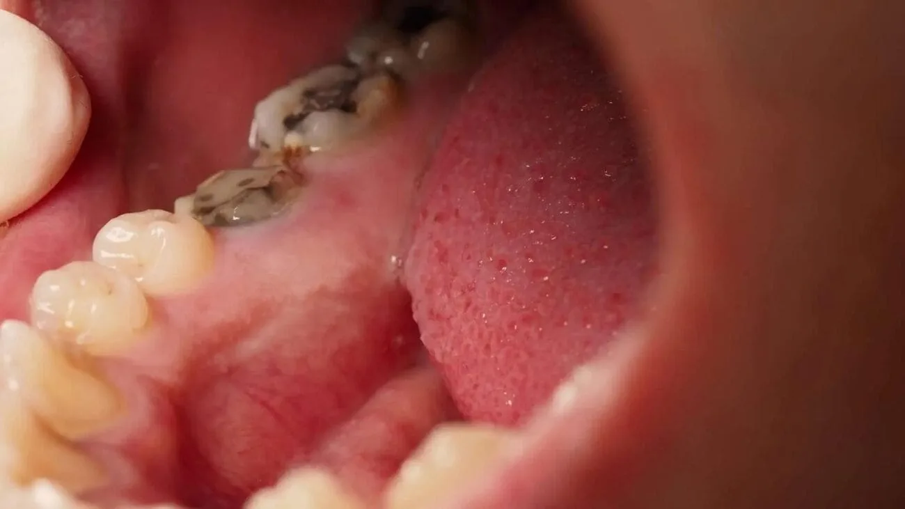 أسباب تسوس الأسنان