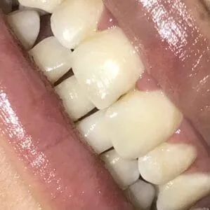 تسوس الأسنان بالصور 