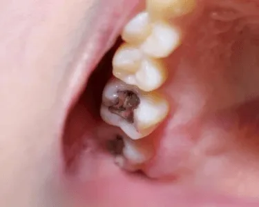 صور لأدوات حشو الأسنان وحشو الأسنان