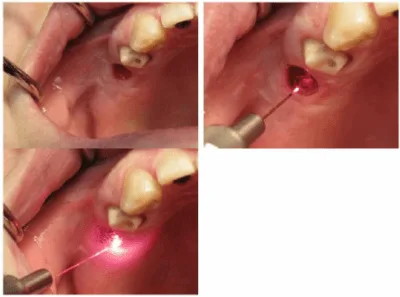 صور زراعة الاسنان بالليزر