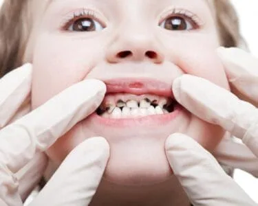 حشوات أسنان الاطفال بالصور