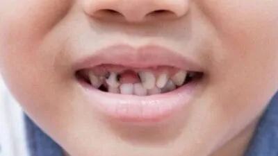 حشوات أسنان الاطفال بالصور