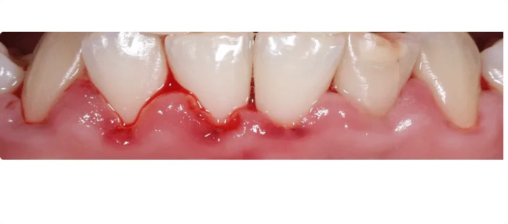 التهاب اللثة التقرحي الحاد الناخر