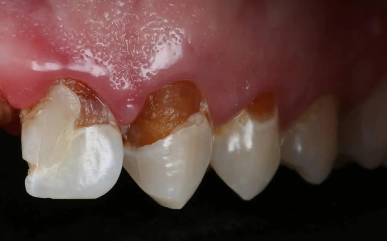 أشكال تسوس الأسنان