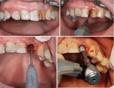صور زراعة الاسنان بالليزر