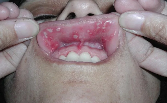 ما هي قرحة الفم؟
