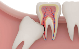 ضرس العقل المدفون: الأسباب، العلاجات، والتجارب