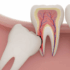 ضرس العقل المدفون: الأسباب، العلاجات، والتجارب