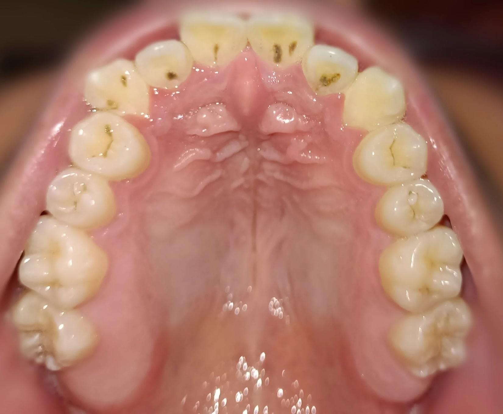 تسوس الأسنان: المراحل والأسباب والعلاج
