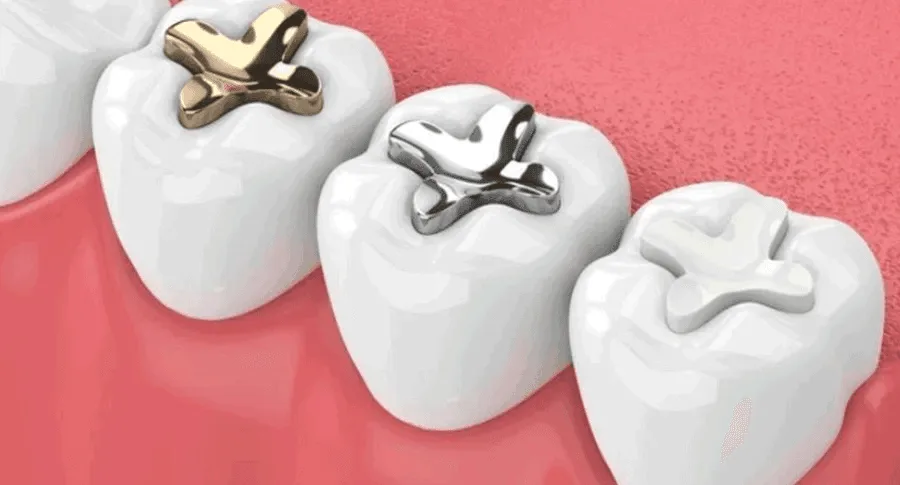 أنواع حشو الأسنان