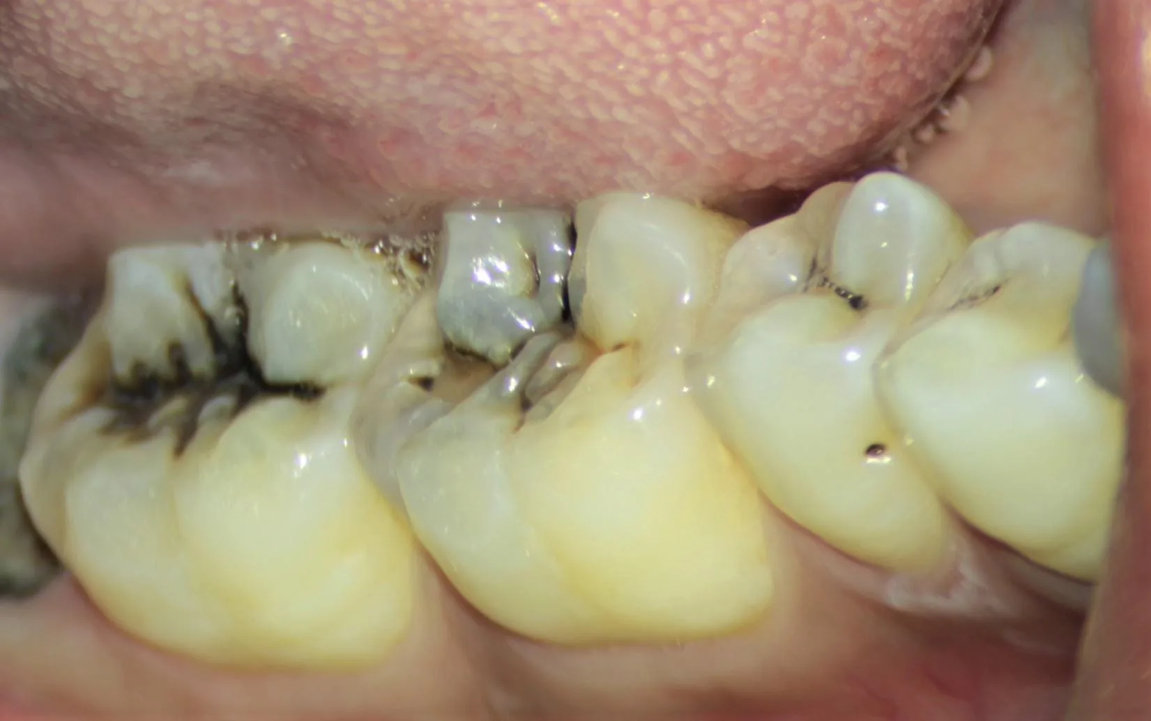 علامات تسوس الأسنان