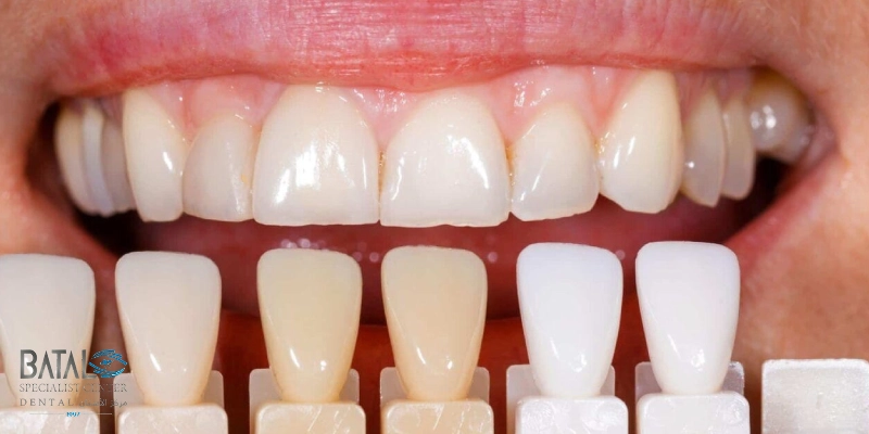 تصنيف درجات ألوان أسنان الزيركون