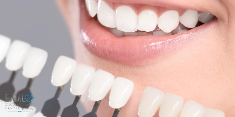 نصائح لاختيار لون الزيركون المناسب للأسنان