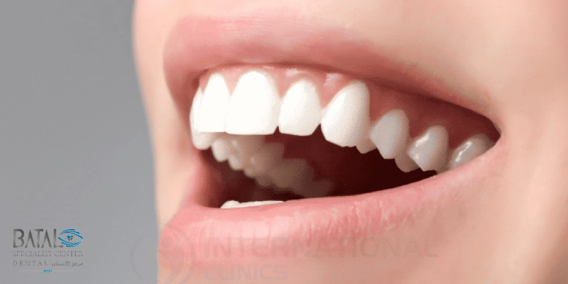 تركيب الزيركون للأسنان