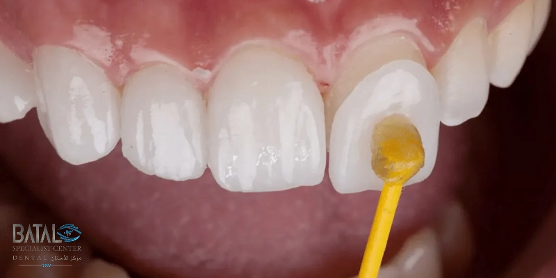 الحالات التي يُنصح فيها باستخدام اللومينير