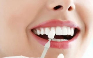 اللومينير: ابتسامة هوليوودية ساحرة