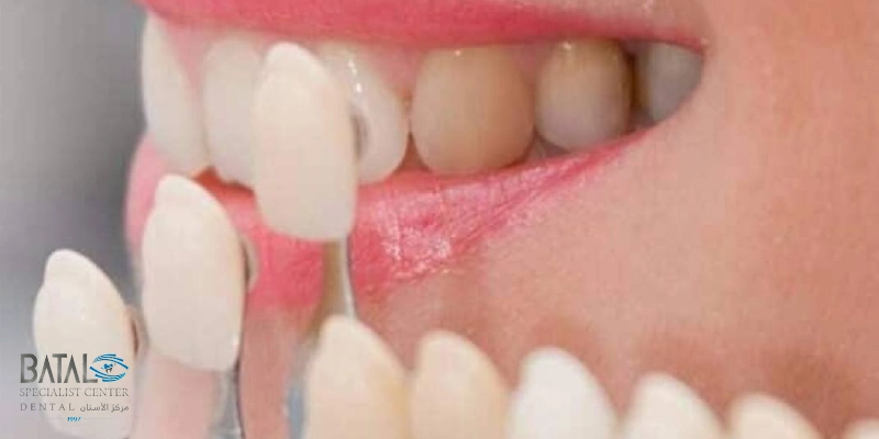 أهم الفروقات بين الفينير واللومينير