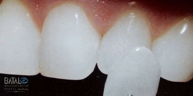 عيوب اللومينير بالمقارنة مع الفينير