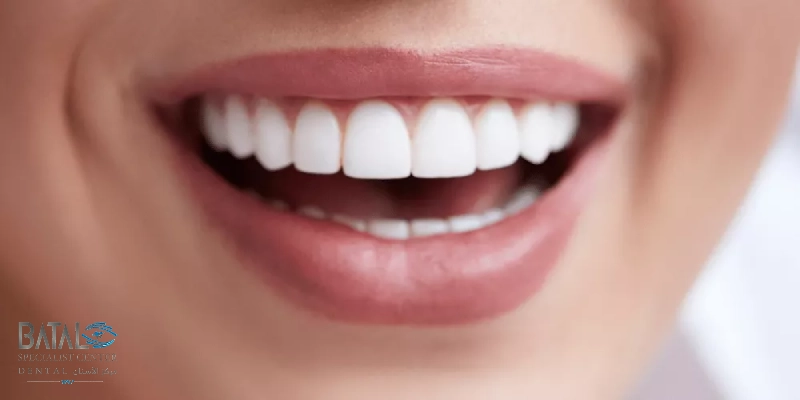 نصائح بعد وضع الفينير أو اللومينير: