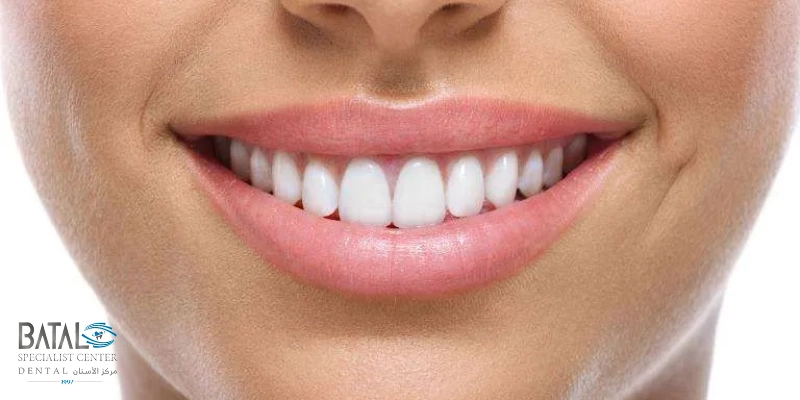 فينير الأسنان