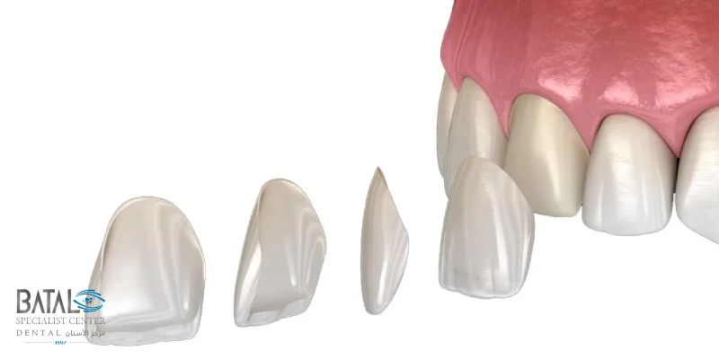 قشور البورسلين